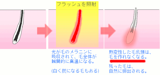 フラッシュ脱毛の原理