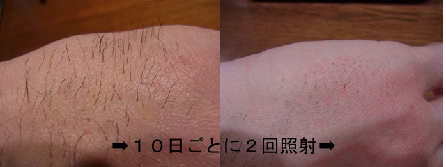 イーモ脱毛体験談 2