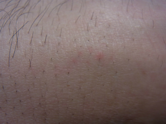 アイシングせずにケノンを照射して少しやけどしました その2