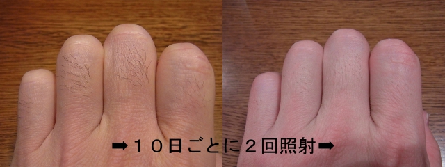 イーモ脱毛体験談 3